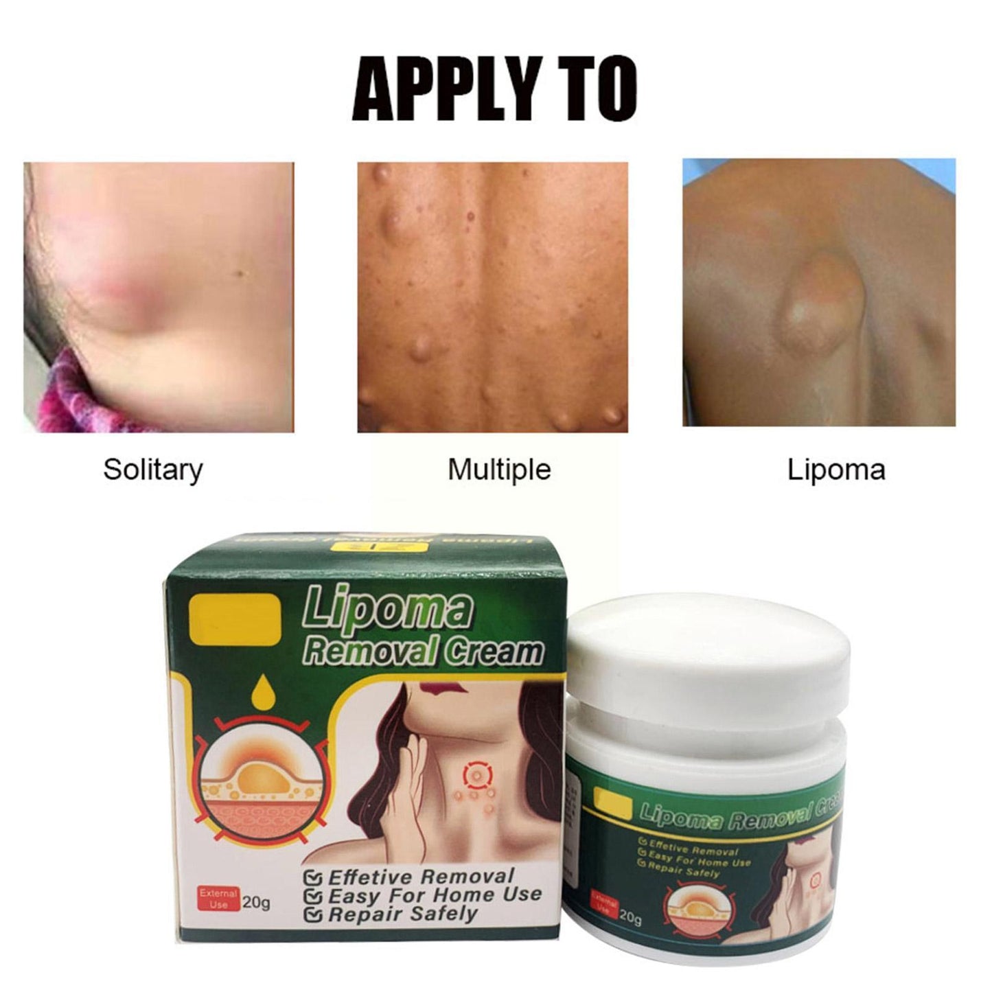 Anti-tumor Lipoma Cream